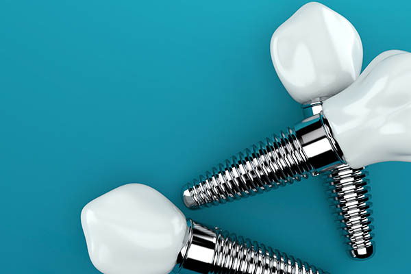 An Implant Dentist Shares About the Tooth Replacement Timeline from Modern Smiles Family Dentistry in Phoenix, AZ