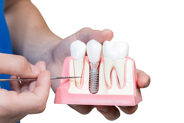 An Implant Dentist Talks About Good Candidates for This Procedure from Modern Smiles Family Dentistry in Phoenix, AZ