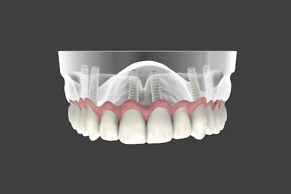 Are Implant Supported Dentures Permanent from Modern Smiles Family Dentistry in Phoenix, AZ