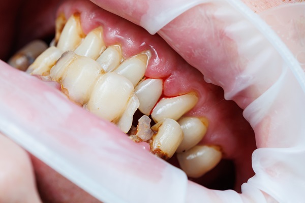 What To Do When You Have A Broken Tooth: Expert Dental Advice