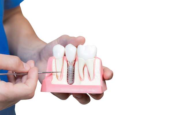 Can You Get Dental Implants if You Have Gum Disease from Modern Smiles Family Dentistry in Phoenix, AZ