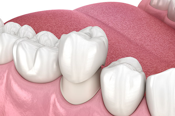 A CEREC® Crown For A Misshapen Tooth