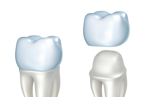 Choose A CEREC Restoration For A Decayed Tooth
