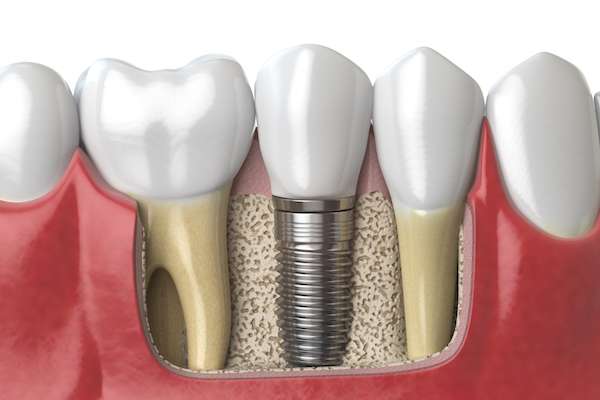 Dental Implants for Replacing Missing Teeth from Modern Smiles Family Dentistry in Phoenix, AZ