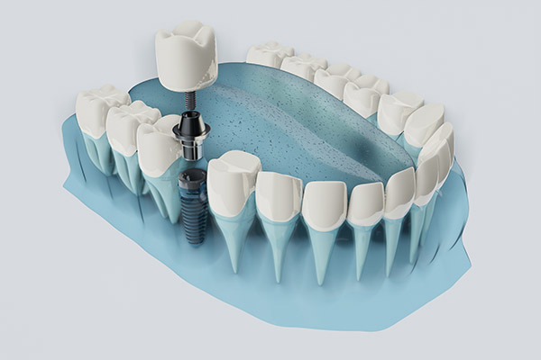 FAQs about Dental Implants from Modern Smiles Family Dentistry in Phoenix, AZ