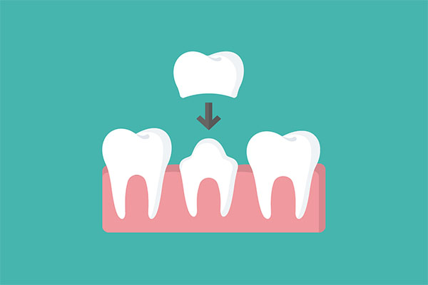 How a CEREC Crown Can  Restore a Broken Tooth from Modern Smiles Family Dentistry in Phoenix, AZ