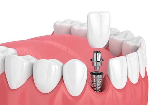 How Painful is Dental Implant Surgery from Modern Smiles Family Dentistry in Phoenix, AZ