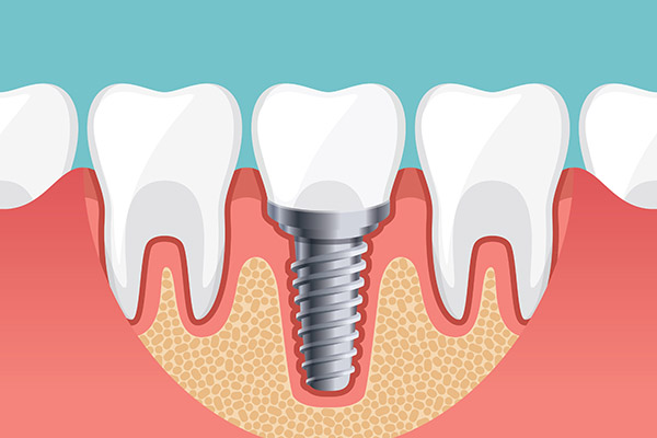 Implant Dentistry Options To Replace a Single Missing Tooth from Modern Smiles Family Dentistry in Phoenix, AZ