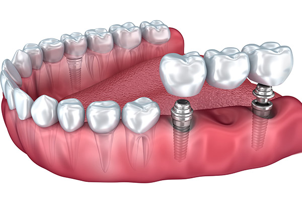 Implant Dentistry Options With Dental Bridges from Modern Smiles Family Dentistry in Phoenix, AZ