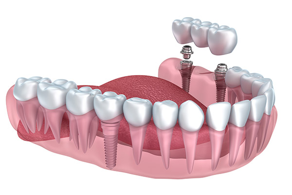 Implant Dentistry Supported Bridge from Modern Smiles Family Dentistry in Phoenix, AZ