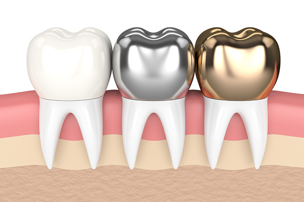 Metal Crowns vs. Porcelain Dental Crowns from Modern Smiles Family Dentistry in Phoenix, AZ