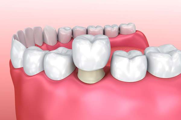 Permanent Dental Crowns vs. Temporary: Is There a Difference from Modern Smiles Family Dentistry in Phoenix, AZ