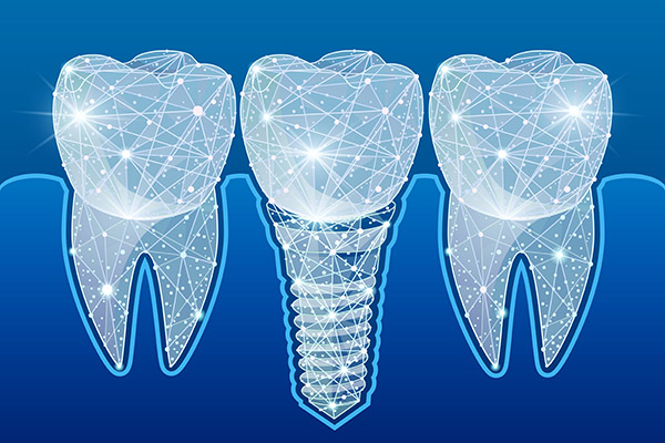 Preventing Complications After Getting Dental Implants from Modern Smiles Family Dentistry in Phoenix, AZ