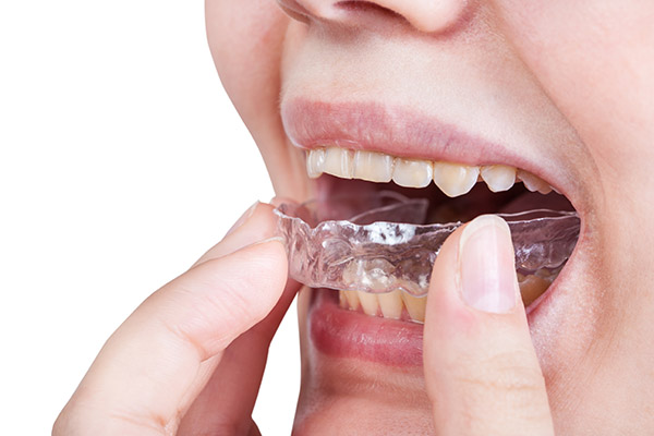 Questions To Ask A Dentist About Clear Aligners