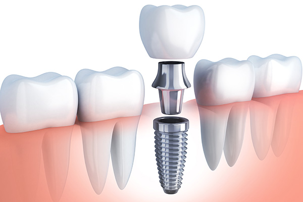Questions to Ask Your Implant Dentist from Modern Smiles Family Dentistry in Phoenix, AZ