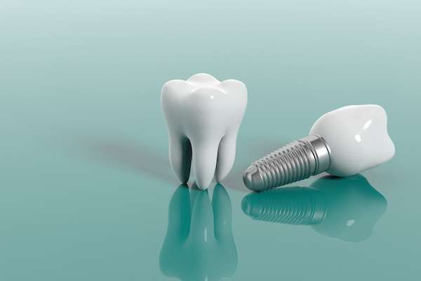 Multiple Teeth Replacement Options: One Implant for Two Teeth from Modern Smiles Family Dentistry in Phoenix, AZ