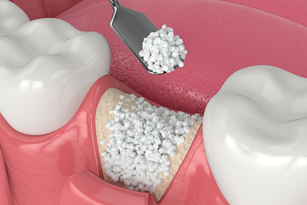 When a Bone Graft Is Needed for an Implant Dentistry Procedure from Modern Smiles Family Dentistry in Phoenix, AZ