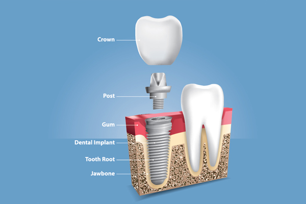 When a Crown Is Placed in the Implant Dentistry Procedure from Modern Smiles Family Dentistry in Phoenix, AZ