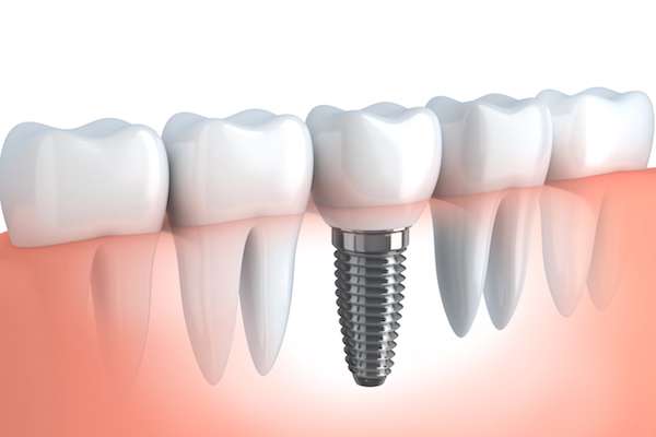 Your Ultimate Guide to Getting Dental Implants from Modern Smiles Family Dentistry in Phoenix, AZ